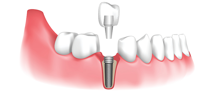 How To Place Dental Implants